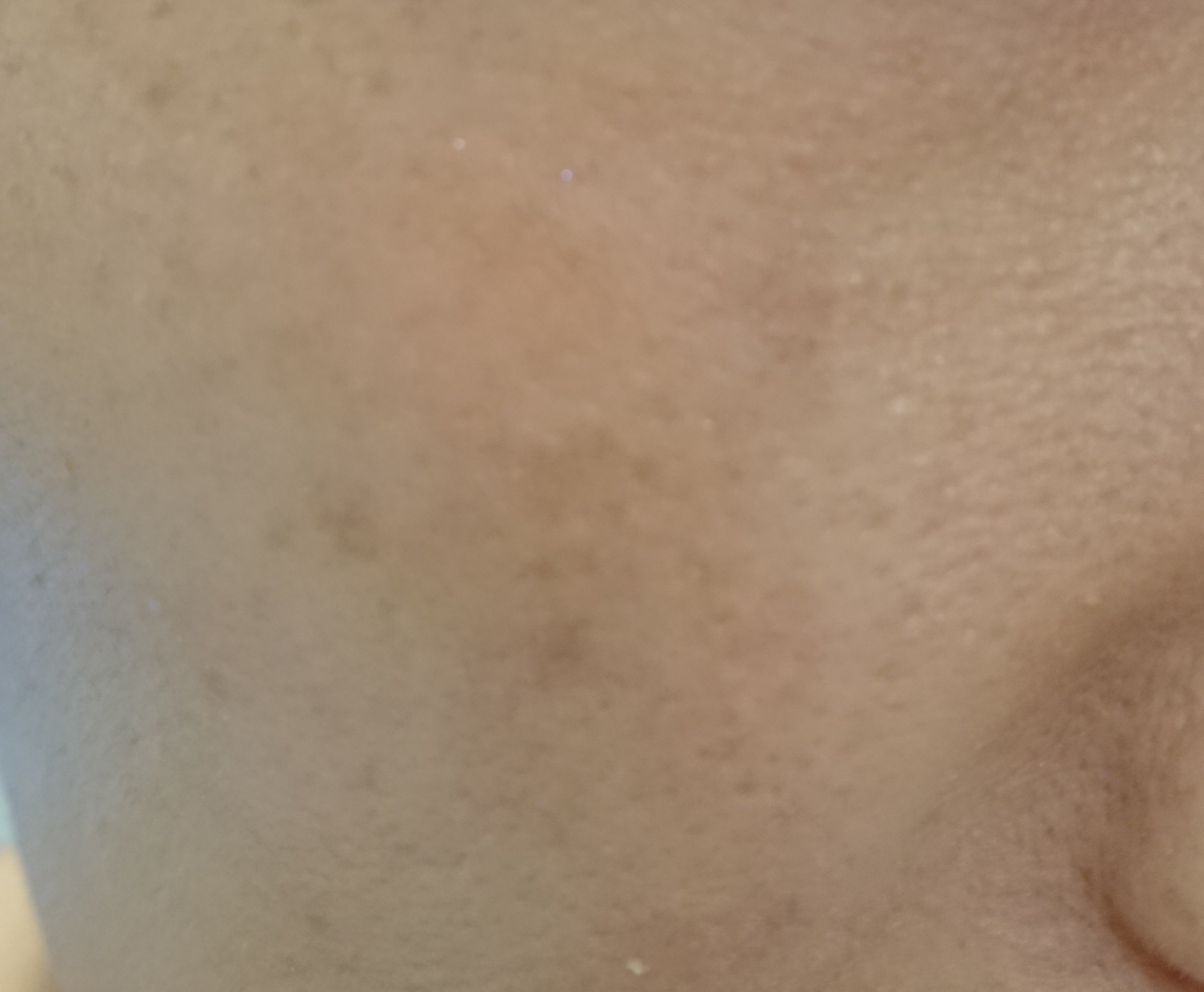 ハイドロキノン