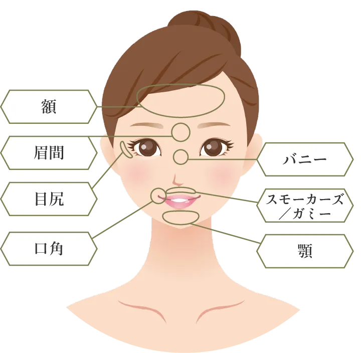 ボトックスの施術可能な場所の画像