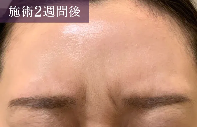 眉間のシワにボトックス注入 症例1施術後