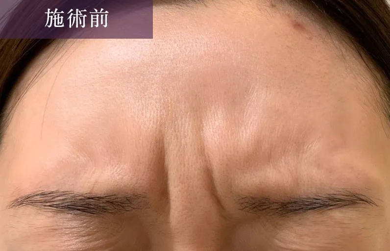 眉間のシワにボトックス注入 症例1施術前