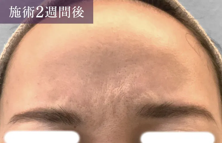 眉間のシワにボトックス注入 症例2施術後