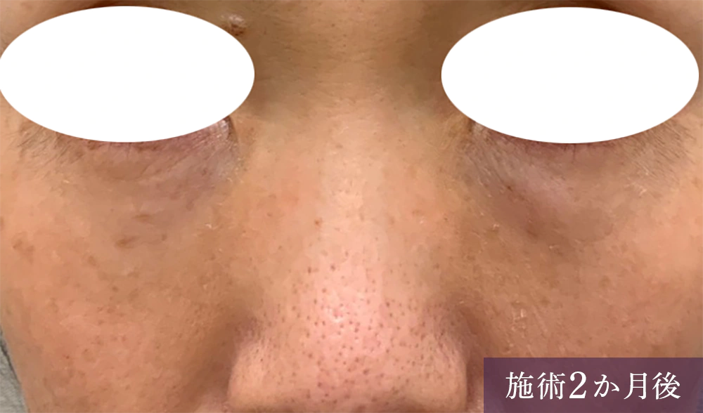 目の下のたるみにスムースアイスペシャル 施術後