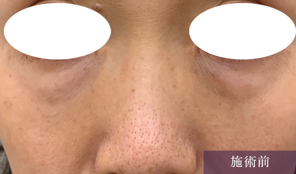 目の下のたるみにスムースアイスペシャル 施術前