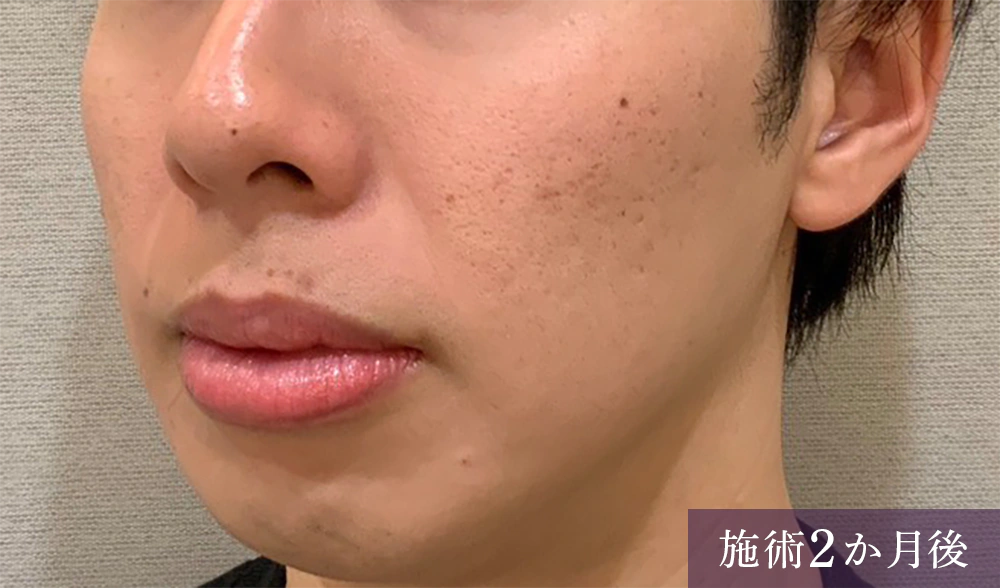 ニキビ跡にフラクショナル 症例2施術後