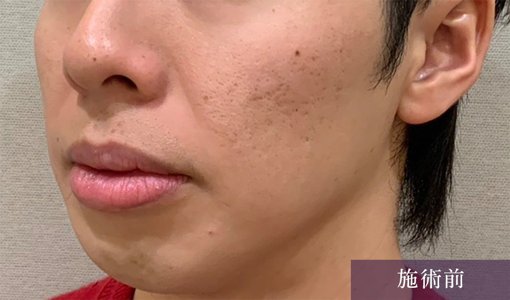 ニキビ跡にフラクショナル 症例2施術前