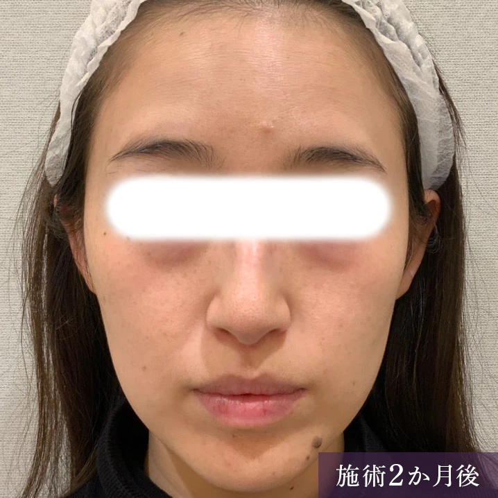 小じわ・くすみにミラーピール 症例3施術後