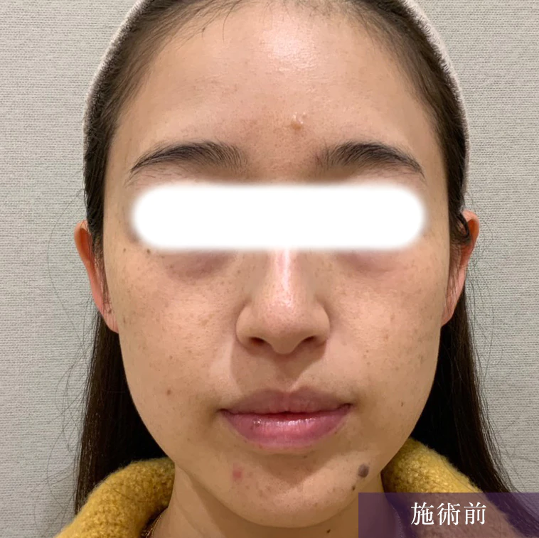 小じわ・くすみにミラーピール 症例3施術前